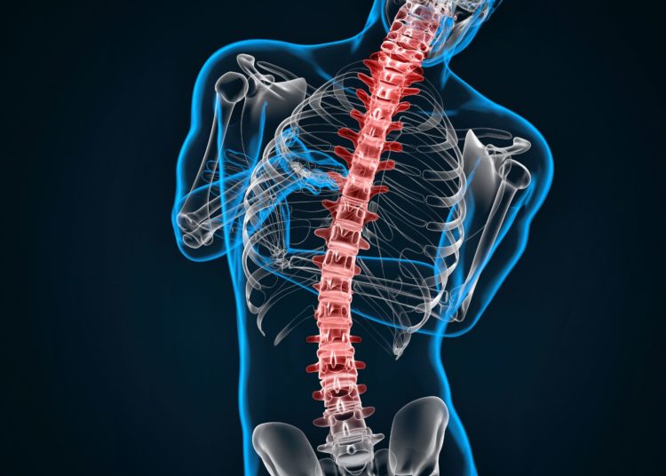 Spondylosis and Scoliosis. 3D illustration. Contains clipping path